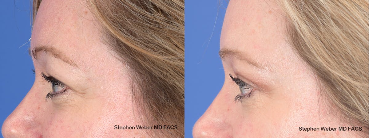 Blepharoplasty Before & After Gallery - Patient 313903 - Image 2