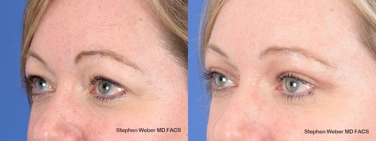 Blepharoplasty Before & After Gallery - Patient 313903 - Image 3