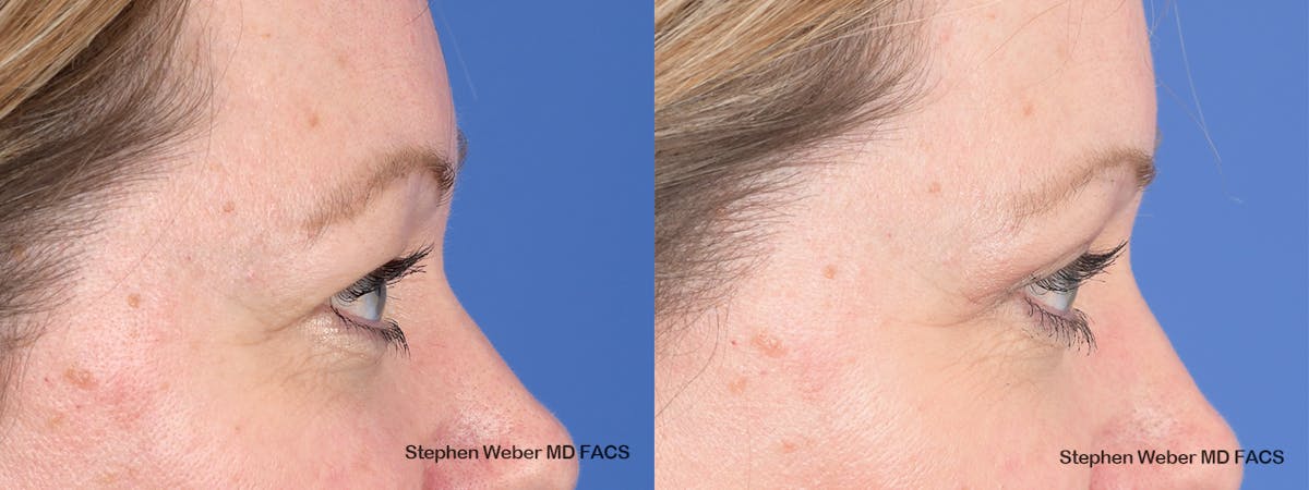 Blepharoplasty Before & After Gallery - Patient 313903 - Image 4