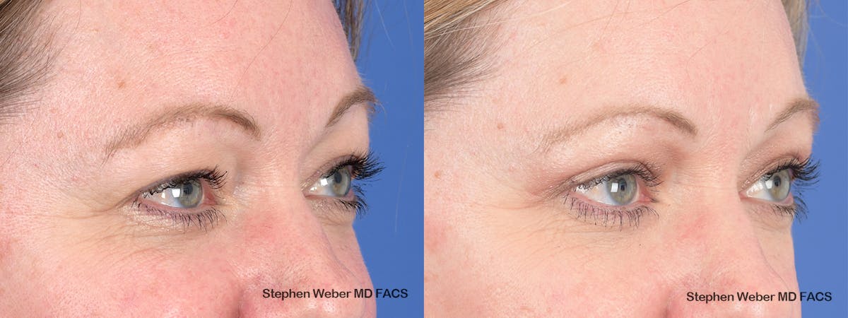 Blepharoplasty Before & After Gallery - Patient 313903 - Image 5