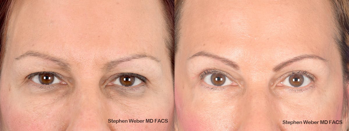Blepharoplasty Before & After Gallery - Patient 285948 - Image 1