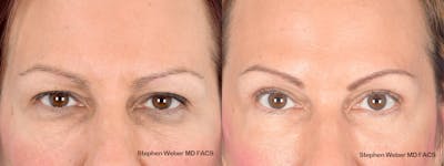 Blepharoplasty Before & After Gallery - Patient 285948 - Image 1