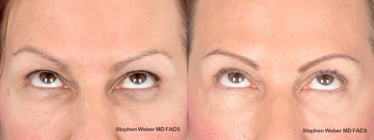 Blepharoplasty Before & After Gallery - Patient 285948 - Image 2