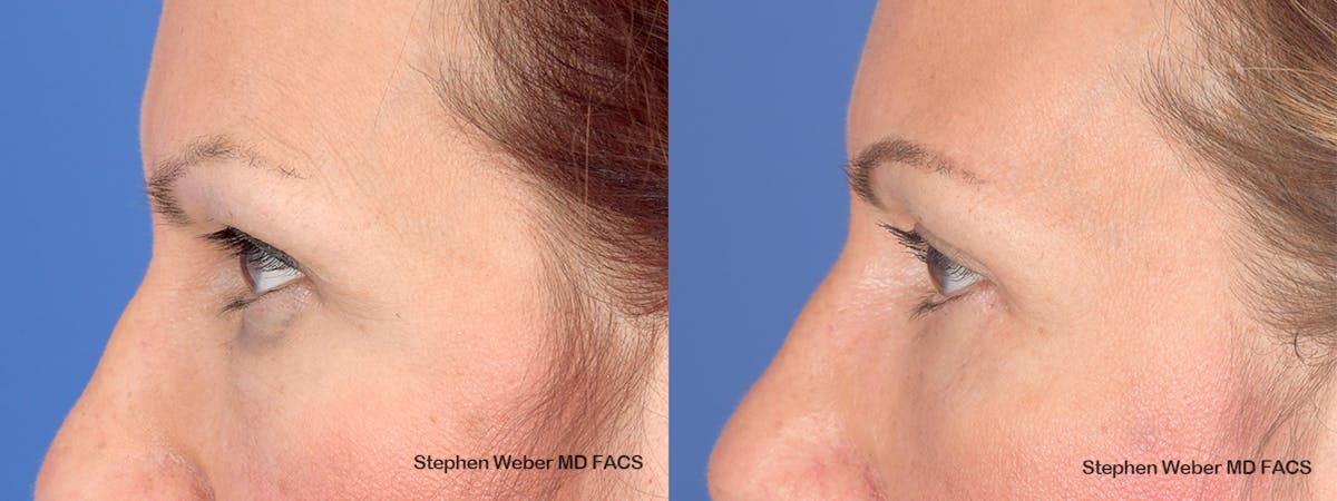 Blepharoplasty Before & After Gallery - Patient 285948 - Image 3
