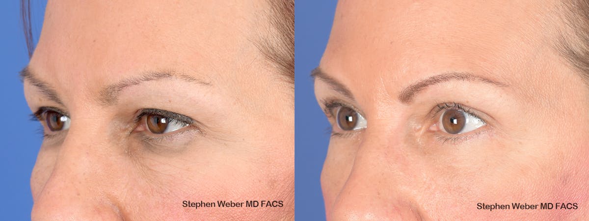 Blepharoplasty Before & After Gallery - Patient 285948 - Image 4