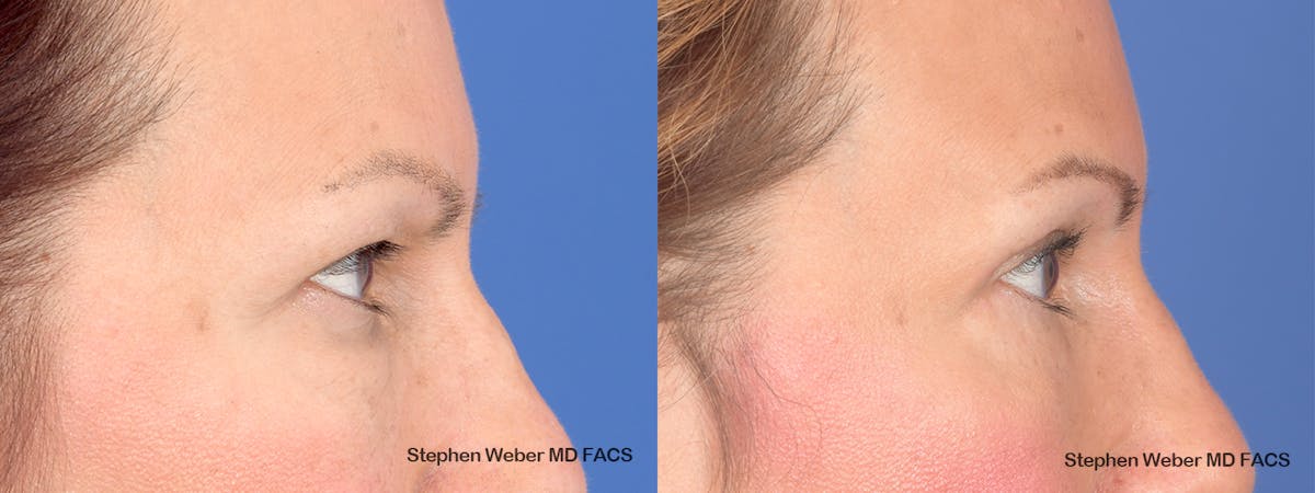 Blepharoplasty Before & After Gallery - Patient 285948 - Image 5