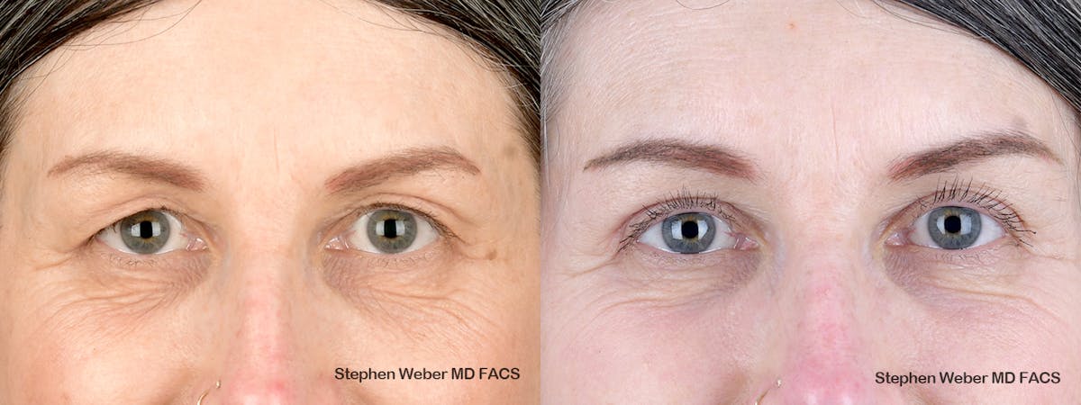 Blepharoplasty Before & After Gallery - Patient 123474 - Image 1