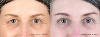 Blepharoplasty Before & After Gallery - Patient 123474 - Image 1