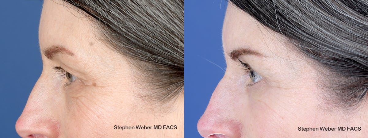 Blepharoplasty Before & After Gallery - Patient 123474 - Image 2