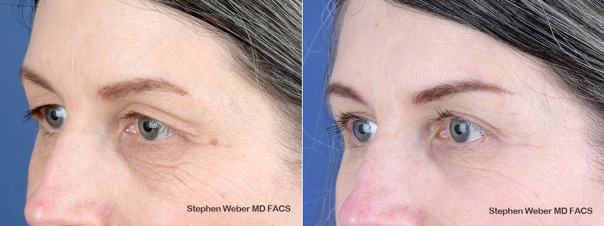 Blepharoplasty Before & After Gallery - Patient 123474 - Image 3