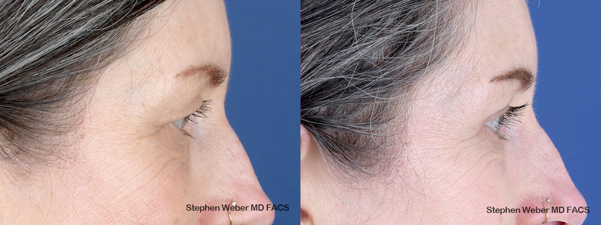 Blepharoplasty Before & After Gallery - Patient 123474 - Image 4