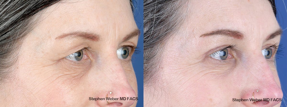 Blepharoplasty Before & After Gallery - Patient 123474 - Image 5