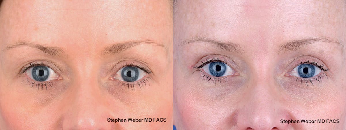 Blepharoplasty Before & After Gallery - Patient 356243 - Image 1