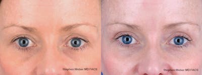 Blepharoplasty Before & After Gallery - Patient 356243 - Image 1