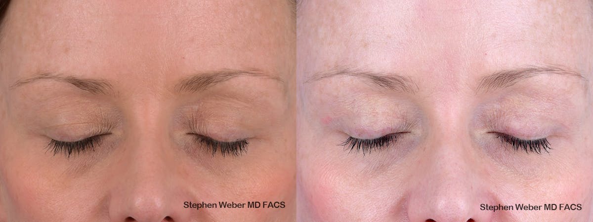 Blepharoplasty Before & After Gallery - Patient 356243 - Image 2