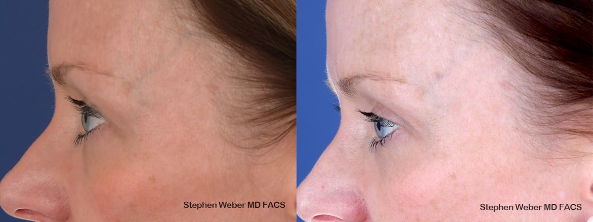 Blepharoplasty Before & After Gallery - Patient 356243 - Image 3