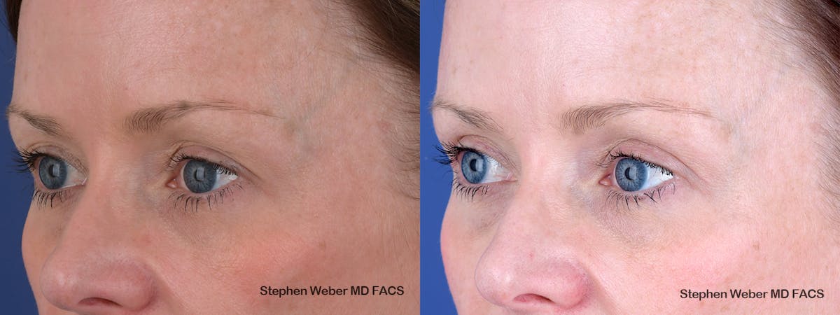Blepharoplasty Before & After Gallery - Patient 356243 - Image 4