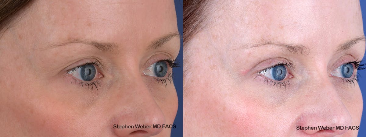 Blepharoplasty Before & After Gallery - Patient 356243 - Image 5