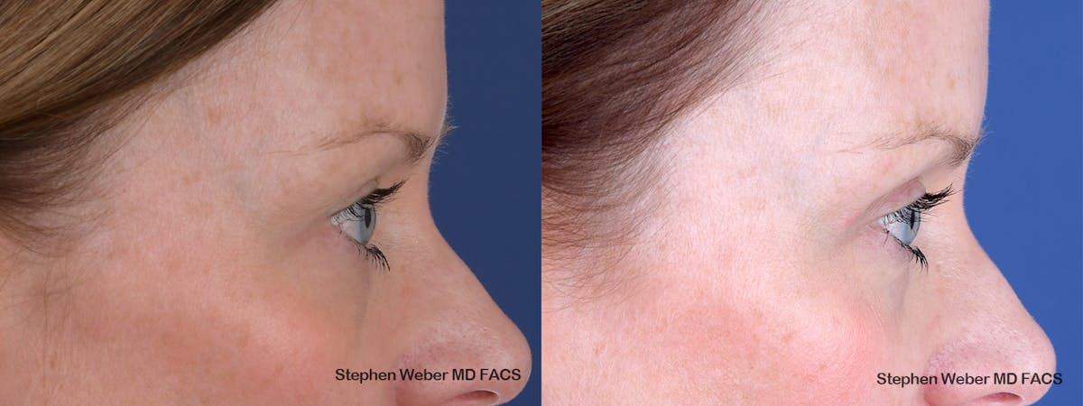 Blepharoplasty Before & After Gallery - Patient 356243 - Image 6