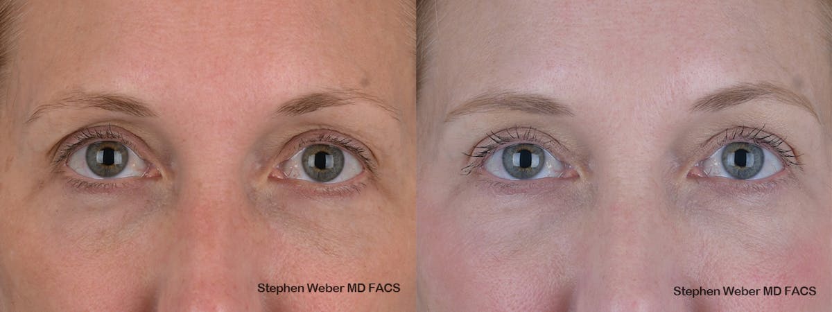 Blepharoplasty Before & After Gallery - Patient 154229 - Image 1