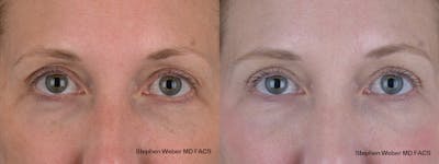 Blepharoplasty Before & After Gallery - Patient 154229 - Image 1