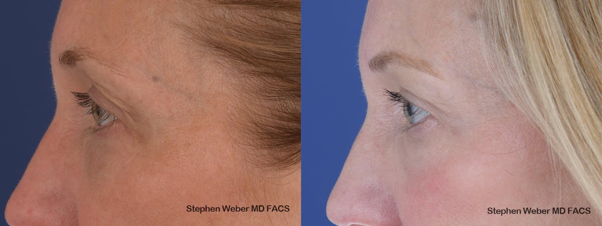 Blepharoplasty Before & After Gallery - Patient 154229 - Image 2