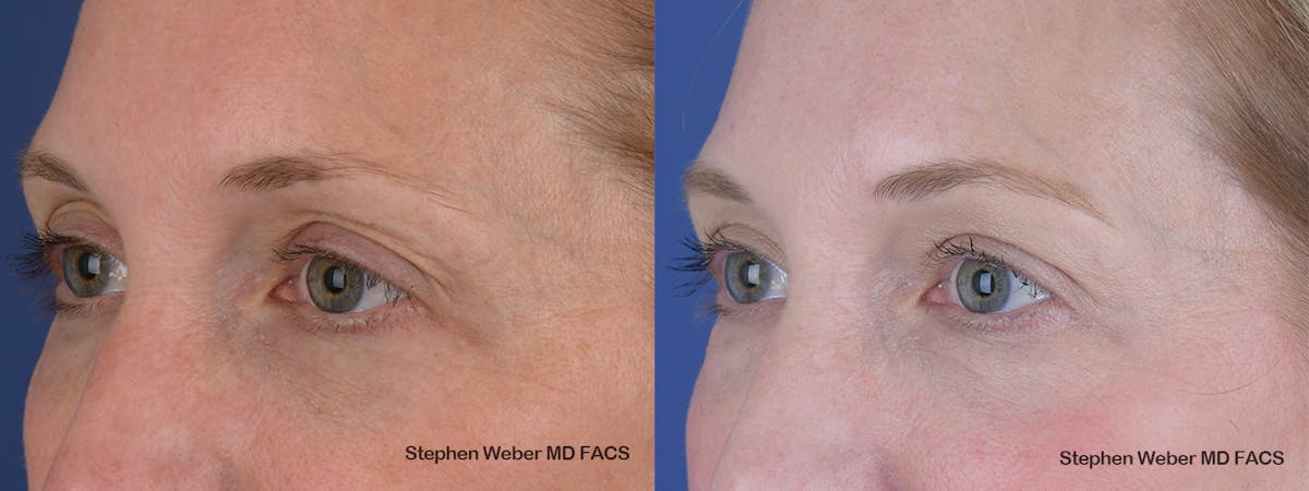Blepharoplasty Before & After Gallery - Patient 154229 - Image 3