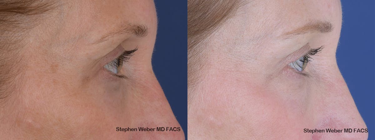 Blepharoplasty Before & After Gallery - Patient 154229 - Image 4