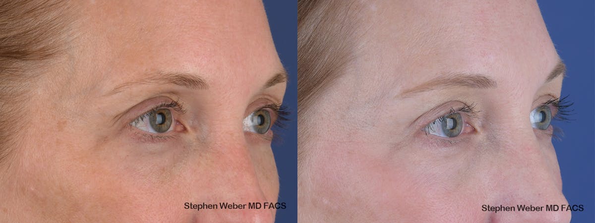 Blepharoplasty Before & After Gallery - Patient 154229 - Image 5