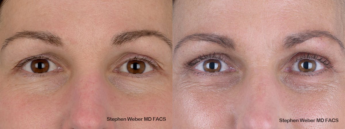 Blepharoplasty Before & After Gallery - Patient 240186 - Image 1