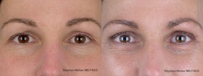 Blepharoplasty Before & After Gallery - Patient 240186 - Image 1