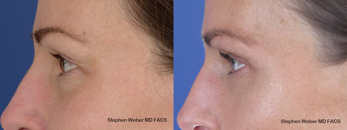Blepharoplasty Before & After Gallery - Patient 240186 - Image 2