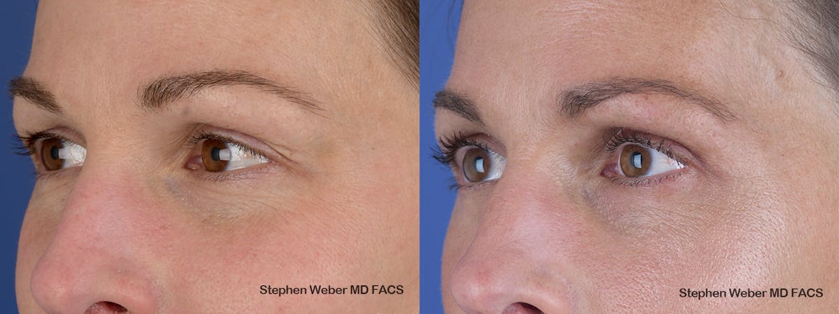 Blepharoplasty Before & After Gallery - Patient 240186 - Image 3