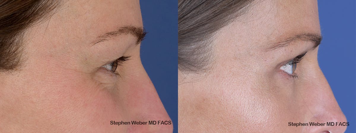 Blepharoplasty Before & After Gallery - Patient 240186 - Image 4