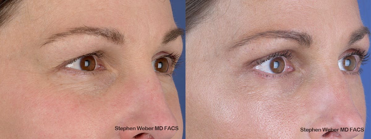 Blepharoplasty Before & After Gallery - Patient 240186 - Image 5