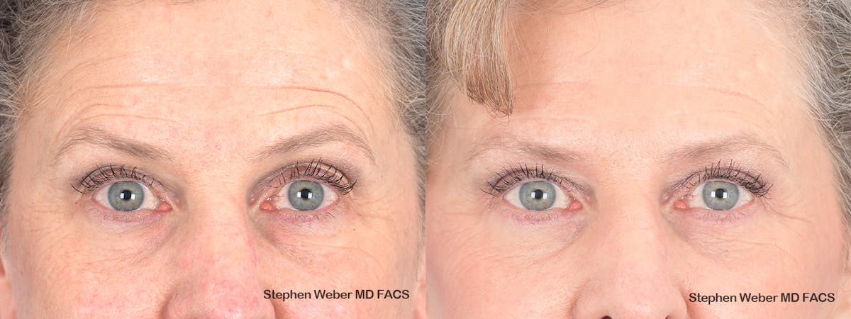 Blepharoplasty Before & After Gallery - Patient 263772 - Image 1
