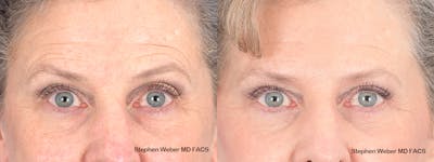 Blepharoplasty Before & After Gallery - Patient 263772 - Image 1