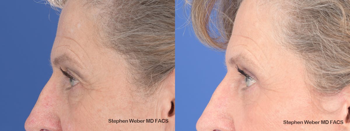 Blepharoplasty Before & After Gallery - Patient 263772 - Image 2