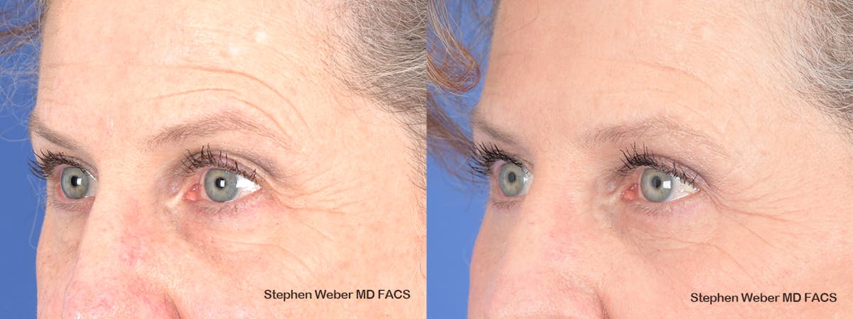 Blepharoplasty Before & After Gallery - Patient 263772 - Image 3