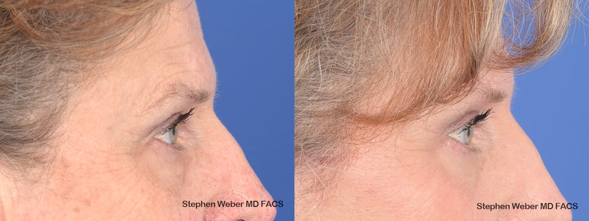 Blepharoplasty Before & After Gallery - Patient 263772 - Image 4