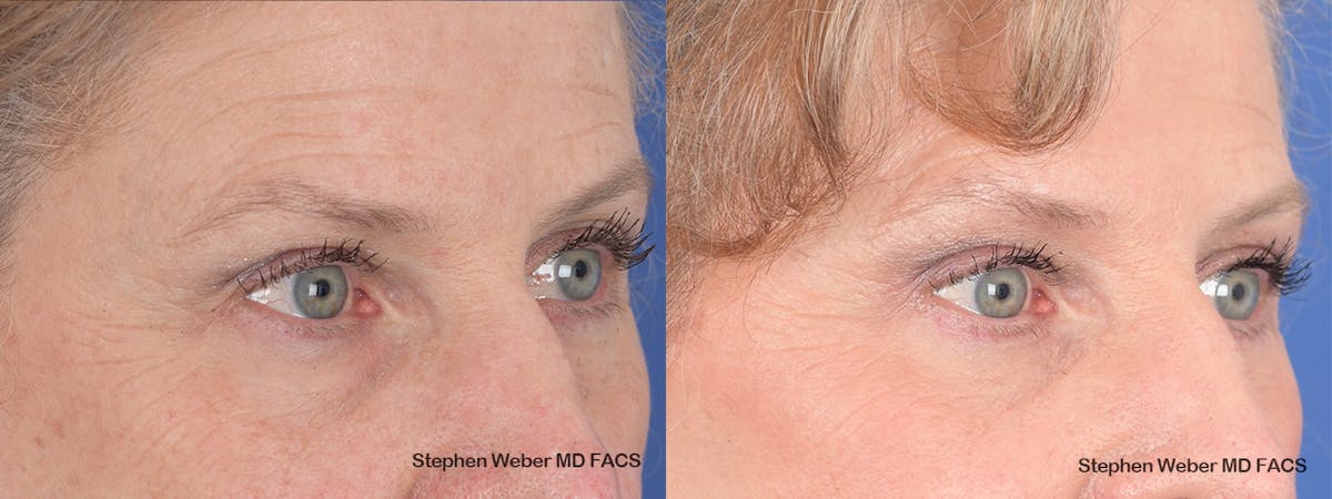 Blepharoplasty Before & After Gallery - Patient 263772 - Image 5