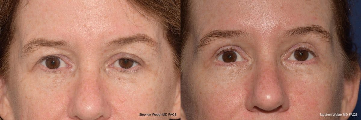 Blepharoplasty Before & After Gallery - Patient 557297 - Image 1