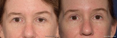 Blepharoplasty Before & After Gallery - Patient 557297 - Image 1