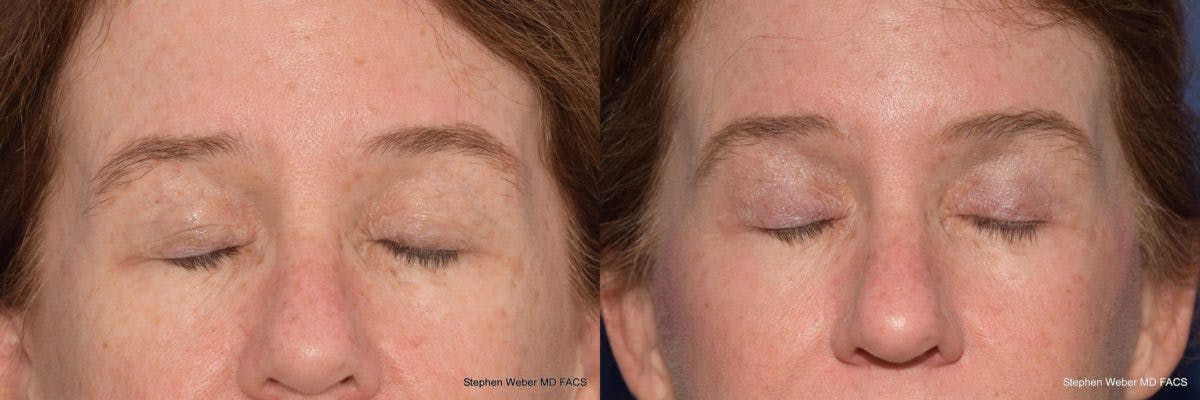 Blepharoplasty Before & After Gallery - Patient 557297 - Image 2