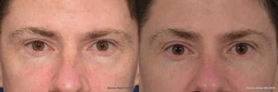 Blepharoplasty Before & After Gallery - Patient 149485 - Image 1