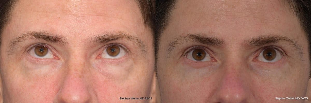 Blepharoplasty Before & After Gallery - Patient 149485 - Image 2
