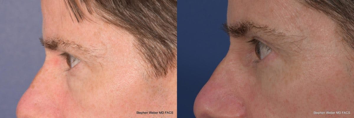 Blepharoplasty Before & After Gallery - Patient 149485 - Image 3