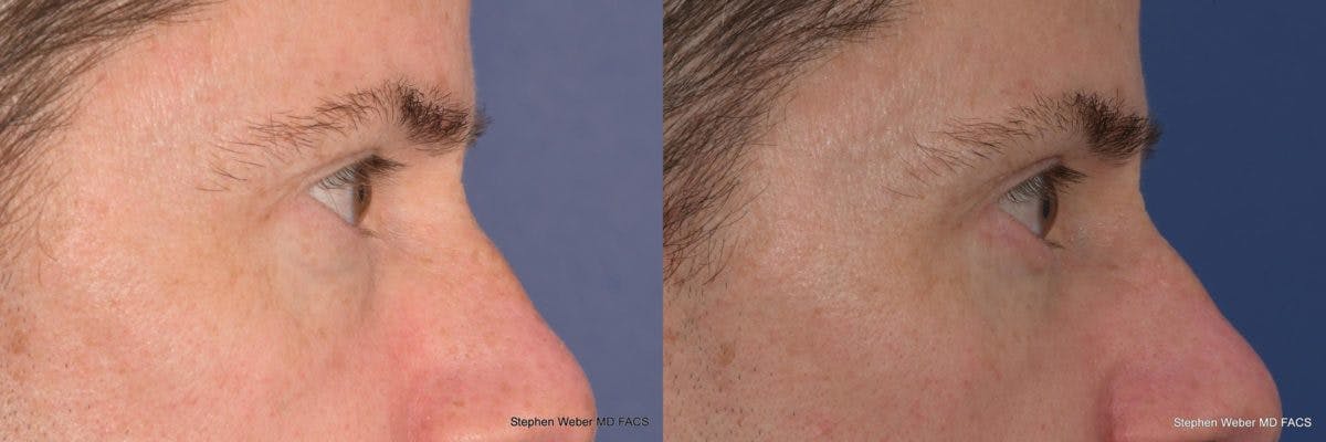 Blepharoplasty Before & After Gallery - Patient 149485 - Image 4