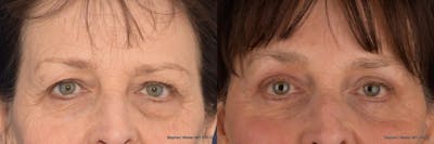 Blepharoplasty Before & After Gallery - Patient 299083 - Image 1