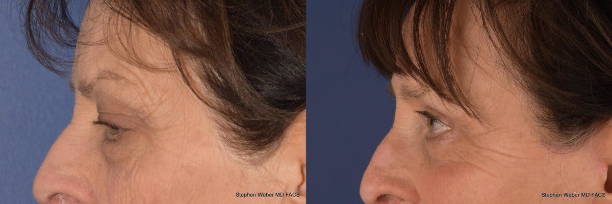 Brow Lift Before & After Gallery - Patient 233864 - Image 2